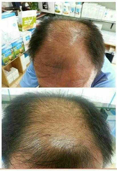 9種中草藥複合配方艾多美生髮液