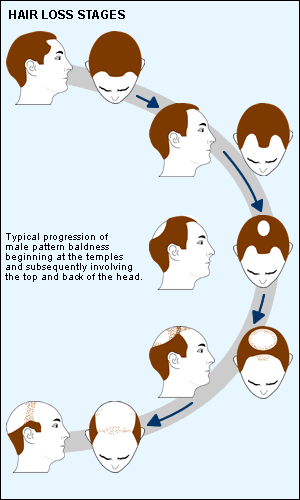 hairloss_stages.gif