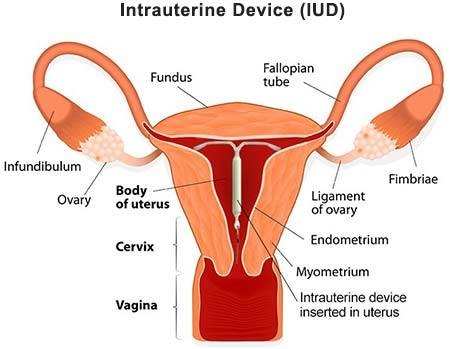 Intrauterine-Device-IUD.jpg