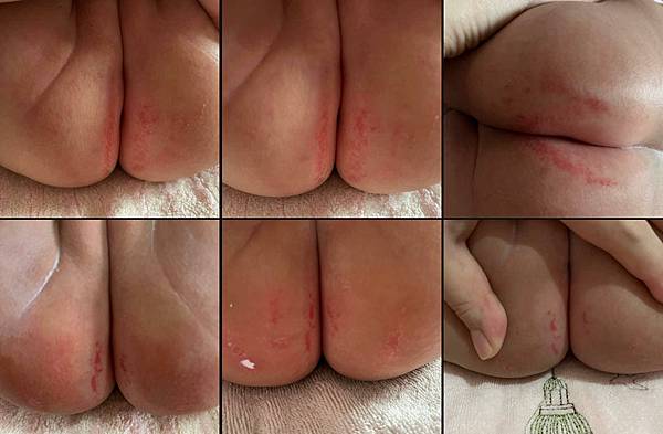 屁葵的拉肚子&紅屁屁破皮之5-6個月的娃生後續之醫生建議事項 屁葵的拉肚子&紅屁屁破皮之5-6個月的娃生後續之醫生建議事項