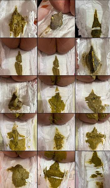 屁葵的拉肚子&紅屁屁破皮之5-6個月的娃生後續之醫生建議事項 屁葵的拉肚子&紅屁屁破皮之5-6個月的娃生後續之醫生建議事項