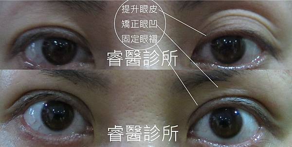 ptosis1-3.jpg