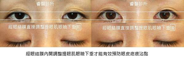 ptosis scarless1.jpg