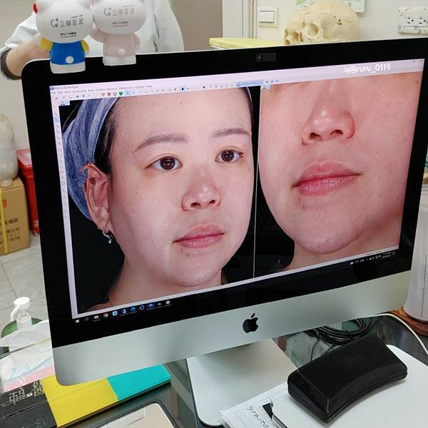 愛美 原來肌膚可以如此好 粉刺無痛bye bye 海菲秀