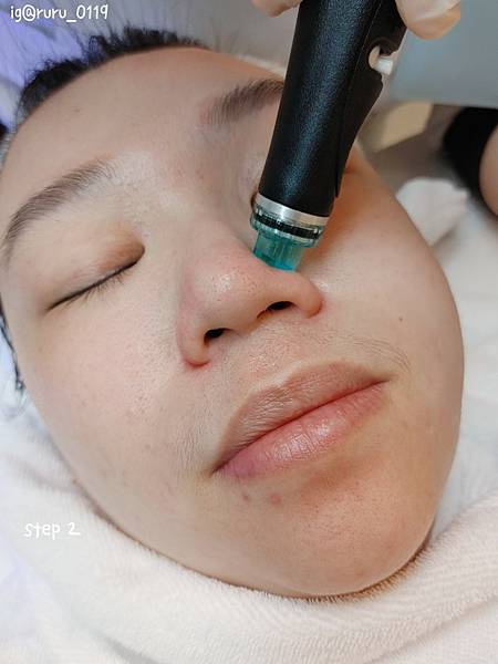 愛美 原來肌膚可以如此好 粉刺無痛bye bye 海菲秀