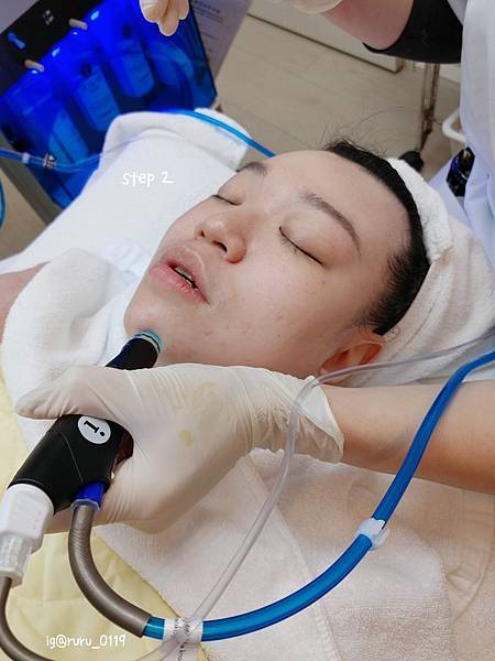 愛美 原來肌膚可以如此好 粉刺無痛bye bye 海菲秀