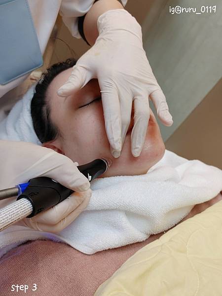 愛美 原來肌膚可以如此好 粉刺無痛bye bye 海菲秀