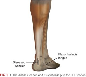 FHL Achilles tendons.jpg FHL Achilles tendons.jpg