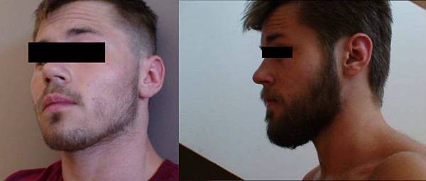 rogaine-facial-hair-before-and-after-results.jpg