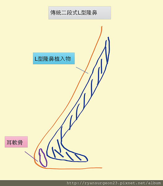 傳統的L型二段式隆鼻