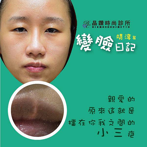 五官變臉日記術後比對照