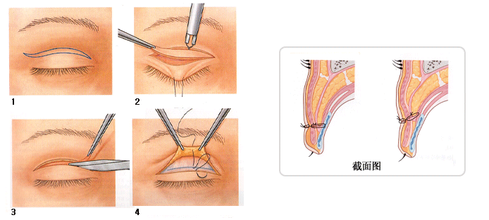 複合式提眼瞼肌手術+割雙眼皮手術