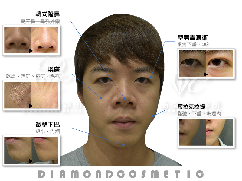 複合式隆鼻與雙眼皮大改造