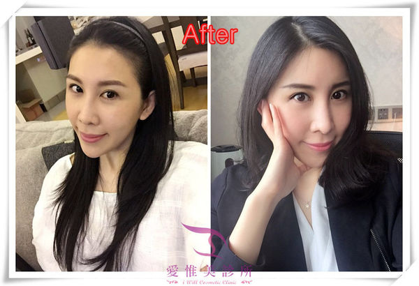 小豬鼻結構式隆鼻術前術後比對照