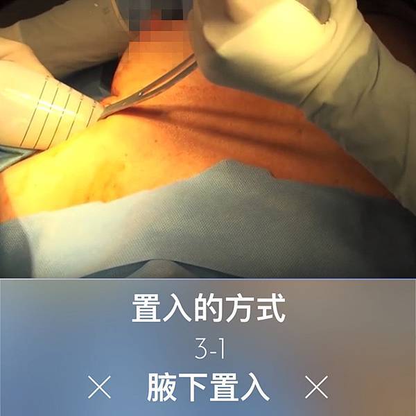 隆乳腋下置入