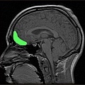 MRI_of_orbitofrontal_cortex.jpg