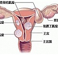 子宮肌瘤