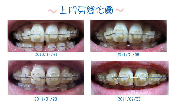門牙變化圖.jpg