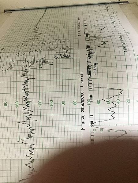 中間一度受藥劑影響導致宮縮過劇壓迫到寶寶心跳，小小病房一下湧入醫生和大批護理人員做緊急處理，醫生後來是幫我把催生劑從陰道取出，寶寶心跳也慢慢回復正常，真的是鬆了一口氣！沒什麼比規律心跳更悅耳的聲音了！