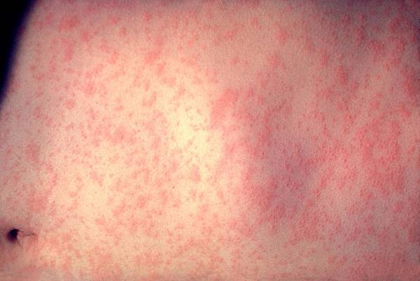 Morbillivirus_measles_infection.jpg