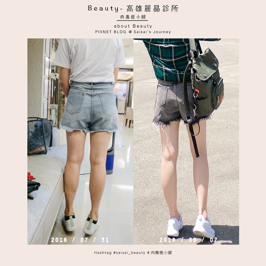 麗晶診所肉毒桿菌瘦小腿肌 01.png 麗晶診所肉毒桿菌瘦小腿肌 01.png