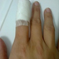 手指頭受傷2