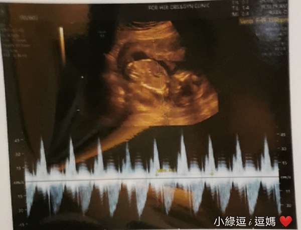 二寶日記 12w 4 開獎日 男孩女孩一樣好兩胎初期症狀比較 小綠逗i逗媽 痞客邦