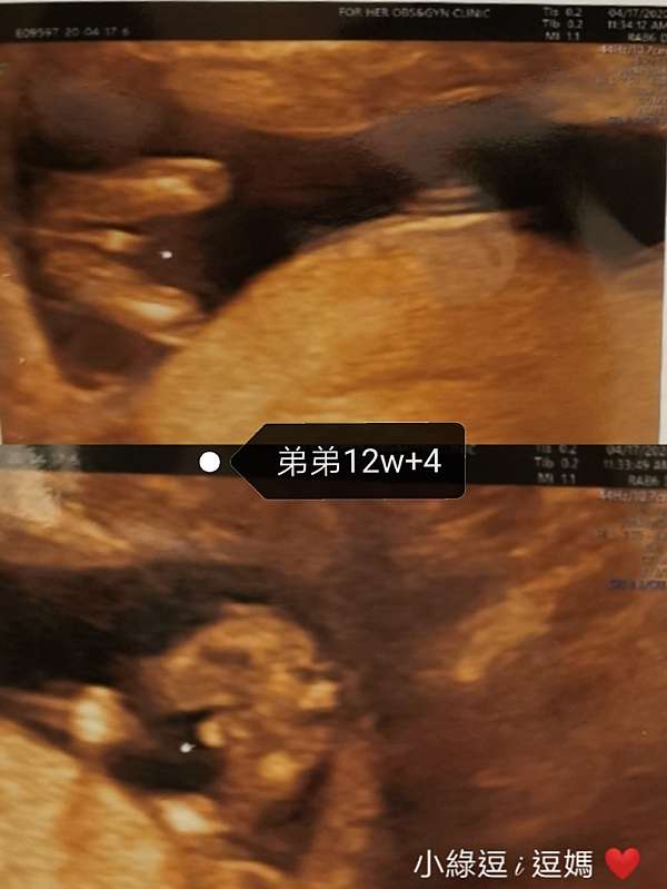 二寶日記 12w 4 開獎日 男孩女孩一樣好兩胎初期症狀比較 小綠逗i逗媽 痞客邦