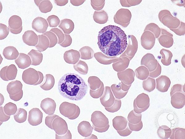 Neutrophil x Eosinophil.jfif Neutrophil x Eosinophil.jfif