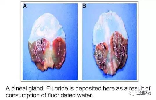 松果体被氟化物沉积的显微照片.jpg