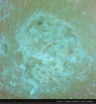 [病毒疣]尋常疣疣體表層黑點處是疣根，火山口凹陷處是病毒分享