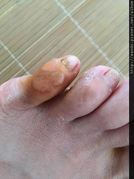 足底的黑傷痕的是艾炙過後未用青草前，足底疣現皮膚已恢復健康