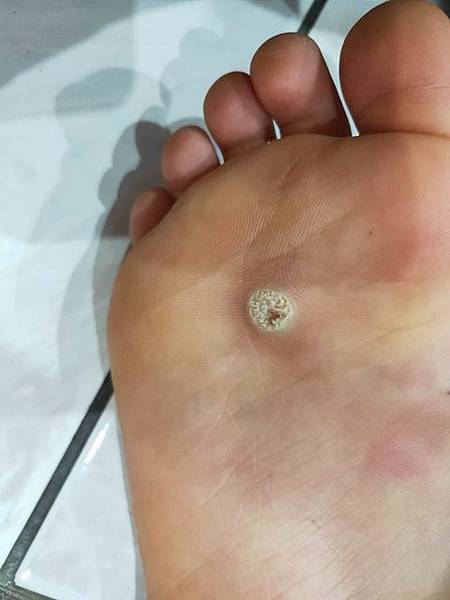 sunny~夏媽妳好~我的疣已經好點了~硬皮都掉了。但是會癢