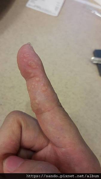 醫生都說沒看過尋常疣長整隻手的，而且冷凍超痛2.jpg