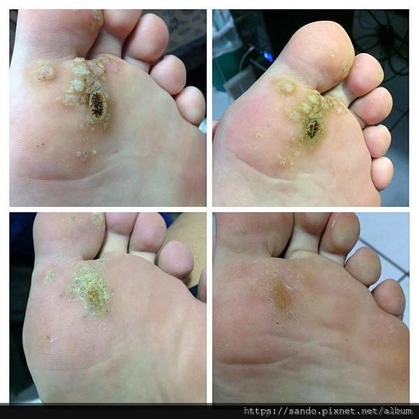 🎈我也line給另一位正想使用的_病毒疣_同病者，鼓勵她，有