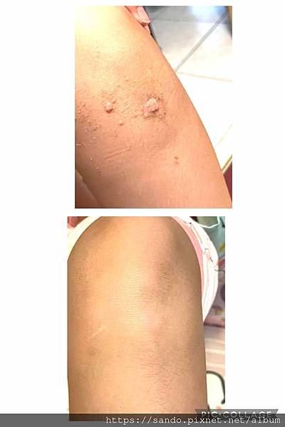 🎈❤️蔡_我兒子上次也是這樣，病毒疣就是擦妳的青草好的，真的