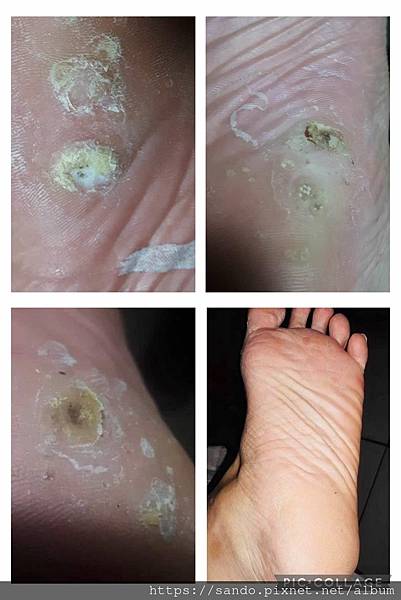 2025-5-9-1(REX CHEN)足底大疣13痊癒.jpg 2025-5-9-1(REX CHEN)足底大疣13痊癒.jpg