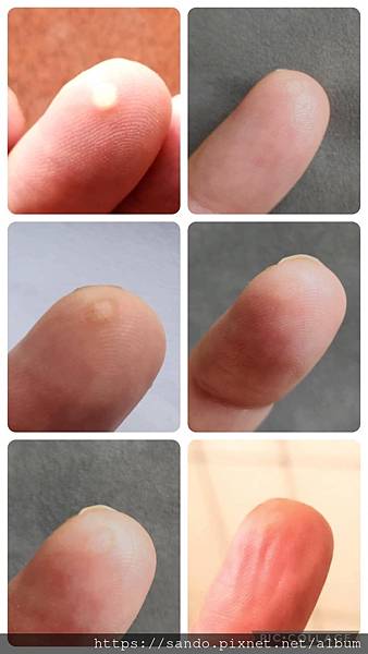 ❤️Yo_夏媽您好!!!之前我買了青草，把手上的疣去除了，到