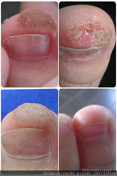 ❤pex_夏媽 您好：感謝您之前介紹的去疣青草，我每天都有照