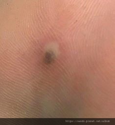 2019-12-5足底整顆脫落1 (2).jpg