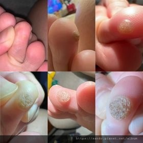 阿凱__有效，真的有效 !!!我糾纏多年，冷凍治療無效的病毒