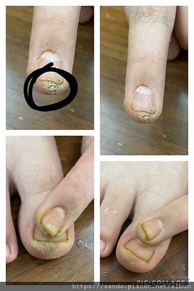 薛旦旦5-手指腳趾疣修復中過程拼圖.jpg