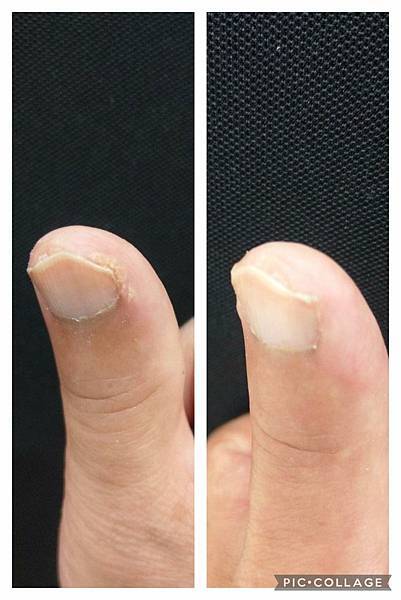 ❤️夏媽的治疣膏我有用過， 因之前右手中指，靠近指甲和肉的接