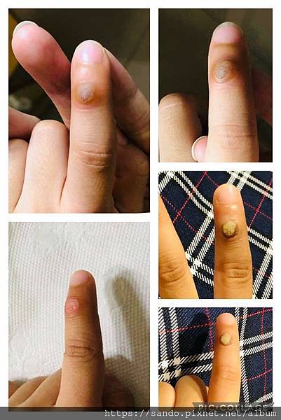 今天兒子要上學，就只能出門前上藥，貼膠帶去學校，等回家再換藥