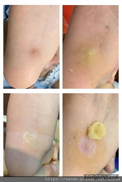 ❤️ Yi Chen___真的很有效！🎈要耐心的擦，不厭其煩