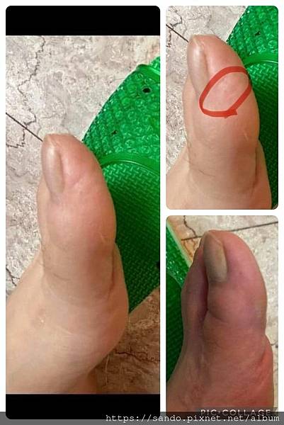 林千金大拇指4痊癒.jpg