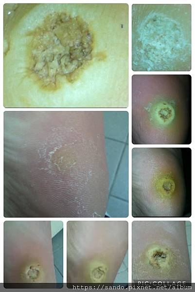 ❤️夏媽你好，這次留言是要來說謝謝的，我的病毒疣已經糾纏了我