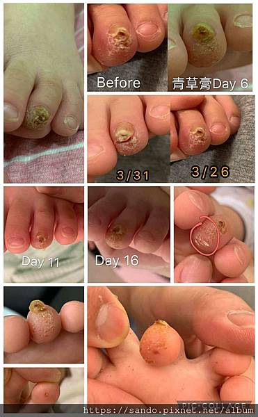 Ming Hsuan Yu小兒足痊癒過程拼圖1.jpg