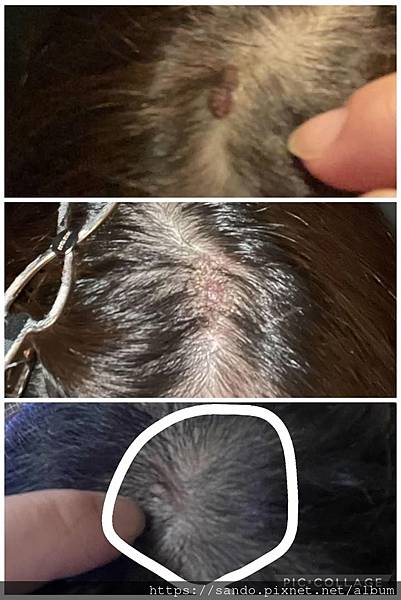 2025-11-3楊敏頭皮痊癒.jpg