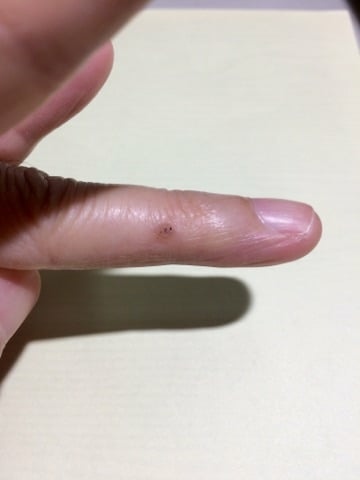 手指尋常疣外貌看似幾個黑點病毒，但皮膚深層底下確似像蜂窩狀病